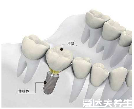 千萬(wàn)不要種植牙，關(guān)于種植牙你必須要知道的四點(diǎn)