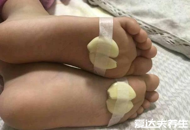 大蒜治咳嗽一夜見效，大蒜切片敷腳心2-3天可以痊愈