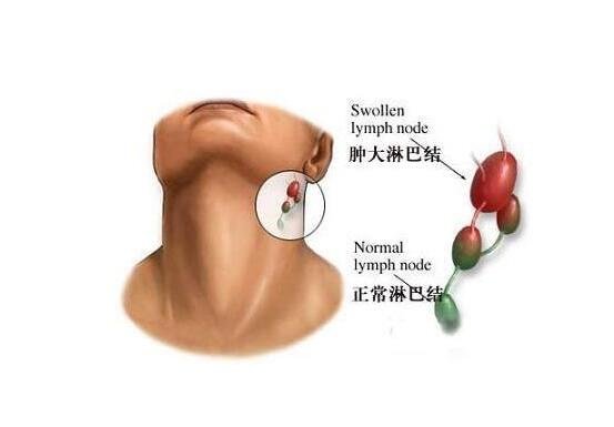 艾滋病自查的10個方法，一招判斷艾滋病(HIV檢測試紙最科學)