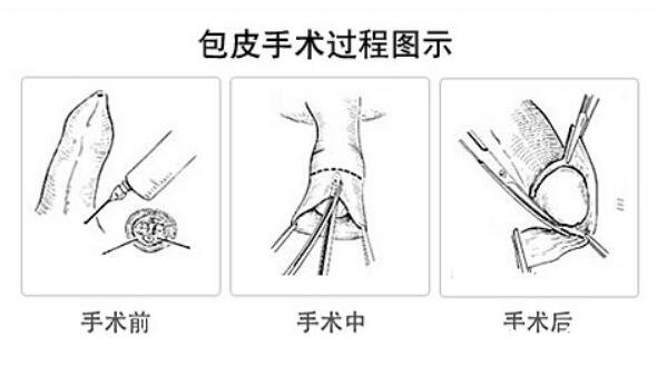 小兒包莖癥狀圖片，不同程度包皮包莖的危害一定要了解