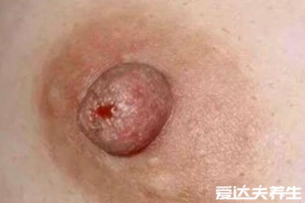 乳腺癌早期癥狀圖片，乳房出現(xiàn)凹陷/乳頭溢液等癥狀需盡快治療