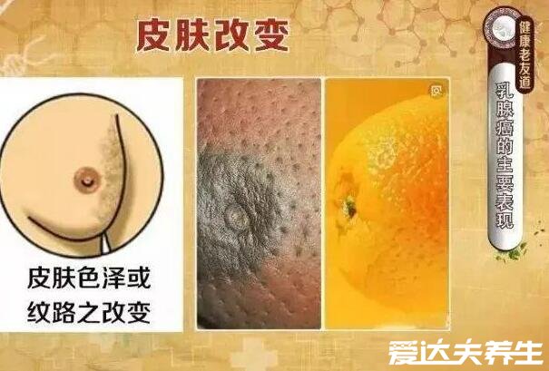 乳腺癌早期癥狀圖片，乳房出現(xiàn)凹陷/乳頭溢液等癥狀需盡快治療