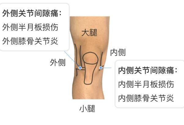 膝蓋各個部位疼痛圖解，不同位置疼痛代表不同疾病(兩側(cè)疼最嚴(yán)重)