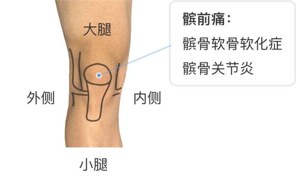 膝蓋各個部位疼痛圖解，不同位置疼痛代表不同疾病(兩側(cè)疼最嚴(yán)重)