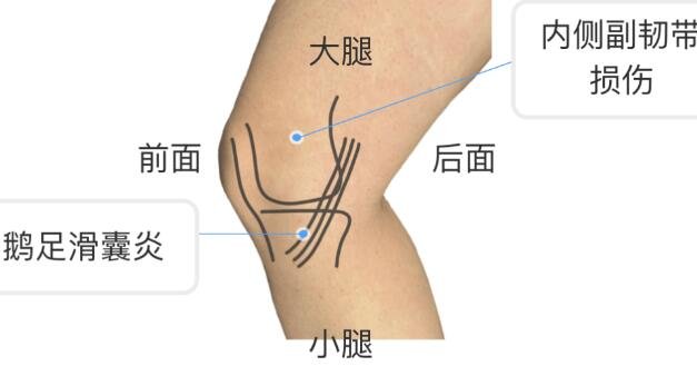 膝蓋各個部位疼痛圖解，不同位置疼痛代表不同疾病(兩側(cè)疼最嚴(yán)重)