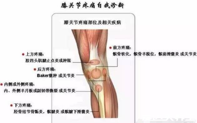 膝蓋各個部位疼痛圖解，不同位置疼痛代表不同疾病(兩側(cè)疼最嚴(yán)重)