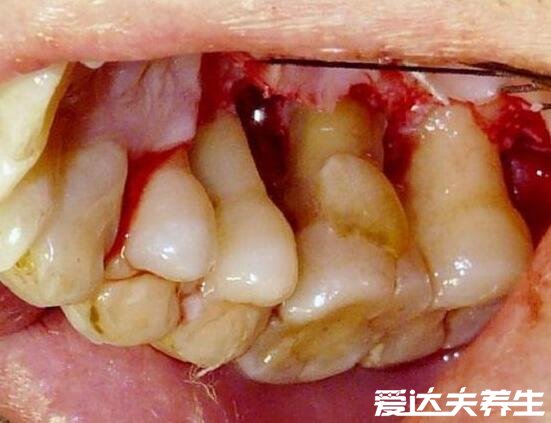 牙周炎圖片癥狀及會傳染嗎，多表現(xiàn)牙齦紅腫有膿血但不會傳染