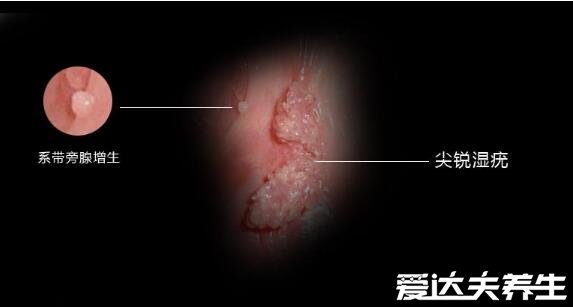 尖濕銳尤典型圖片，尖銳濕疣早期癥狀真假辨別