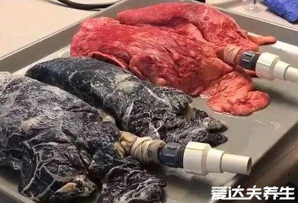 抽了一年電子煙的肺部像70歲老人，充滿煙油導致無法呼吸(真實病例)