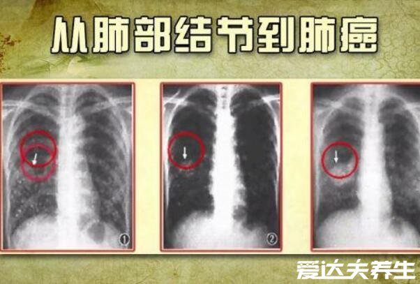 肺結(jié)節(jié)10個人9個人有嗎，不準確但發(fā)病率很高(警惕肺癌)