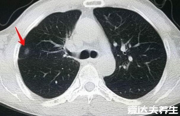 肺結(jié)節(jié)10個人9個人有嗎，不準確但發(fā)病率很高(警惕肺癌)