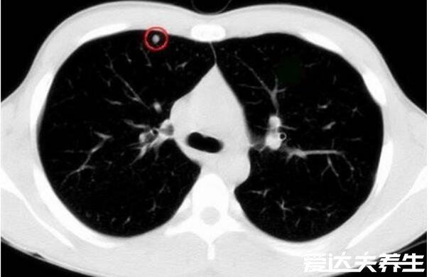 肺結(jié)節(jié)10個人9個人有嗎，不準確但發(fā)病率很高(警惕肺癌)