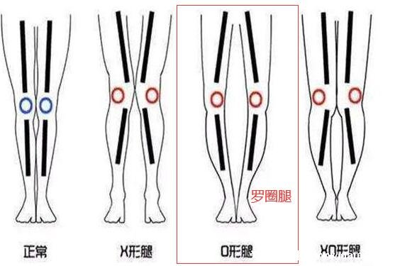 羅圈腿圖片癥狀及矯正方法，呈膝蓋外翻可通過(guò)運(yùn)動(dòng)改善