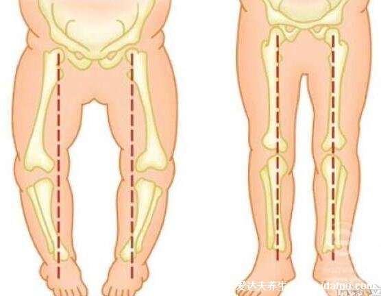 羅圈腿圖片癥狀及矯正方法，呈膝蓋外翻可通過(guò)運(yùn)動(dòng)改善