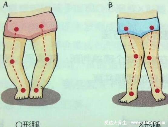 羅圈腿圖片癥狀及矯正方法，呈膝蓋外翻可通過(guò)運(yùn)動(dòng)改善