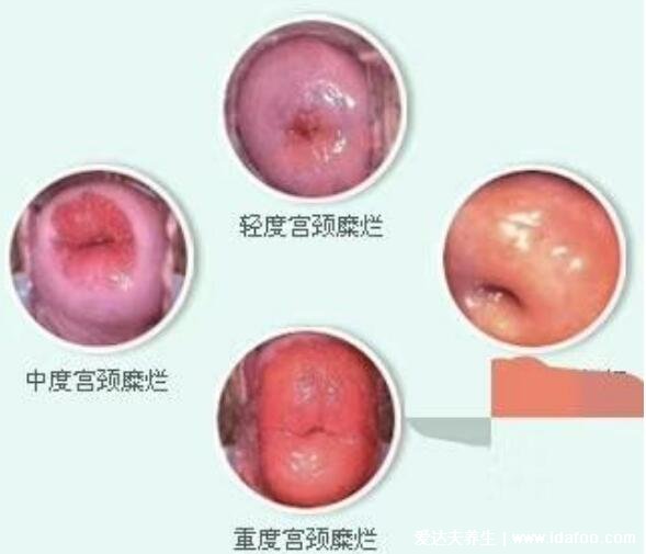 宮頸糜爛一二三度圖片及癥狀，女性一定要重視發(fā)展成宮頸癌就晚了