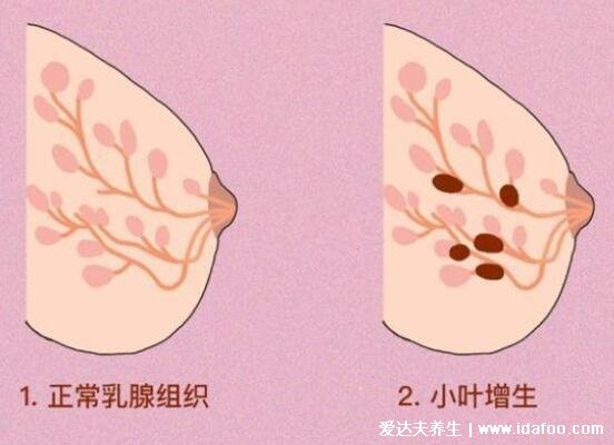 乳腺增生和正常乳腺圖片手感，一個柔軟一個異物感強烈區(qū)別很大