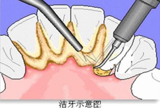 洗牙一次大概多少錢左右，能管多久(一百元可管一年)