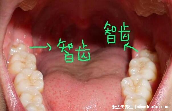 一次拔兩顆智齒后悔死了，看清不需要拔的智齒圖片