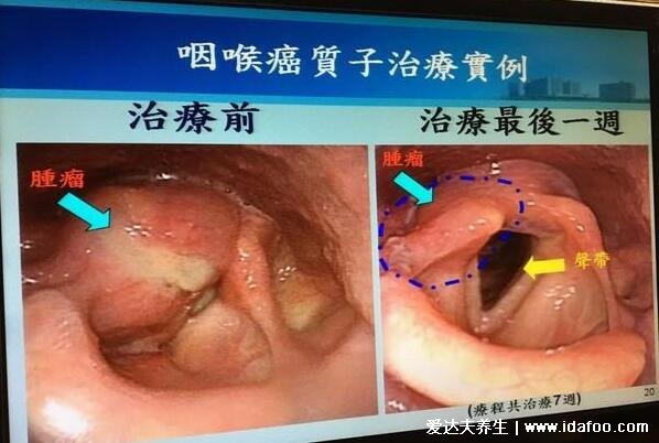 女性咽喉癌的早期癥狀，五大早期癥狀明顯感覺咽喉有異物(圖片)