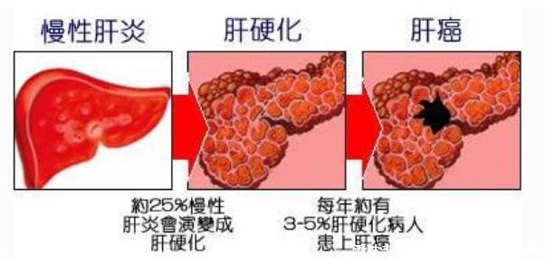 7大肝硬化早期癥狀，警惕蜘蛛痣和肝掌的出現(xiàn)