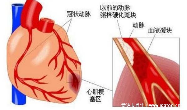 心肌梗塞的前兆和表現(xiàn)，四大癥狀牙疼也可能是心梗前兆