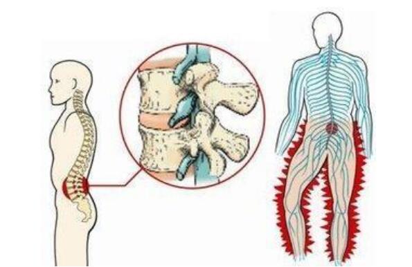 腰椎間盤突出壓迫神經(jīng)腿疼怎么治，藥物和保守療法一般不需要手術(shù)