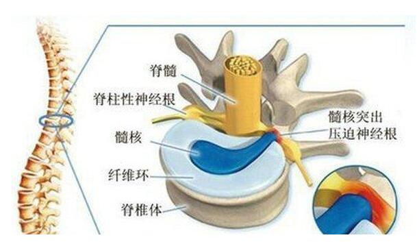 腰椎間盤突出壓迫神經(jīng)腿疼怎么治，藥物和保守療法一般不需要手術(shù)