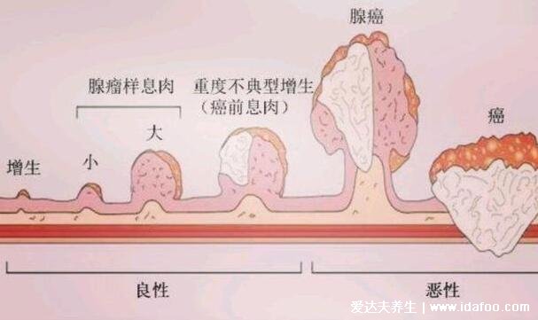 直腸癌早期的5大癥狀，左下腹肛門隱隱作痛伴隨大便變細(xì)帶血