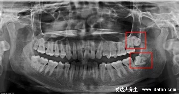 人為什么會長智齒，只有30%的幸運(yùn)兒不長智齒(附史上最難拔的智齒圖)