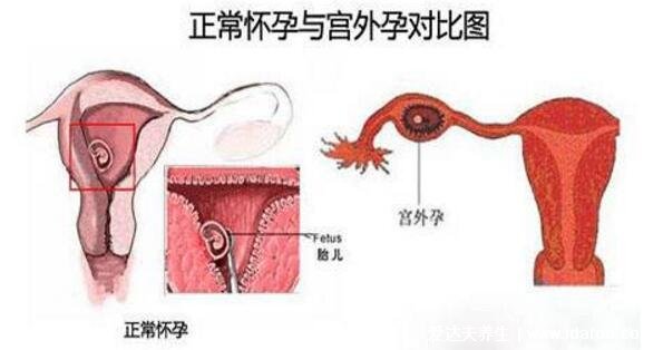 為什么會(huì)宮外孕，宮外孕的癥狀有哪些表現(xiàn)(4大原因)