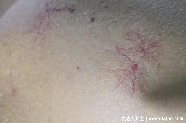 真實蜘蛛痣圖片，多發(fā)于青春期女性(附肝癌右肩痛位置圖)