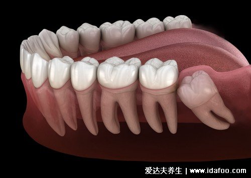 智齒有必要拔嗎，智齒一定要拔嗎？(視情況而定)