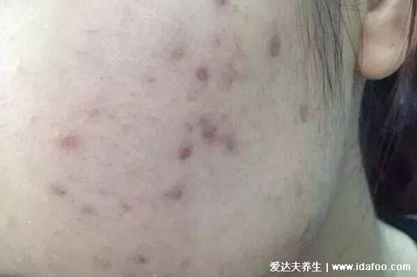 16個去除痘印的小妙招，白芷粉加蜂蜜敷臉淡斑祛痘印