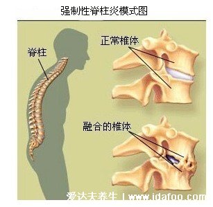 右后背痛病情對照圖，需警惕四種?。ㄅ愿椎蔑L濕）