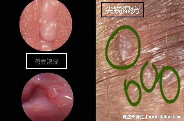 假疣和真疣的區(qū)別圖，不要把這兩個認錯了