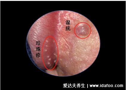 假疣和真疣的區(qū)別圖，不要把這兩個認錯了