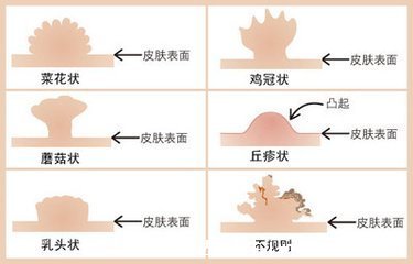 假疣和真疣的區(qū)別圖，不要把這兩個認錯了