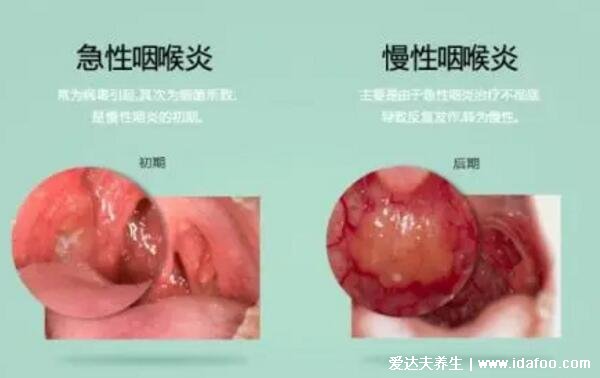 一勺白醋治好咽炎是真的嗎，對輕微咽炎有一些好處但效果不佳