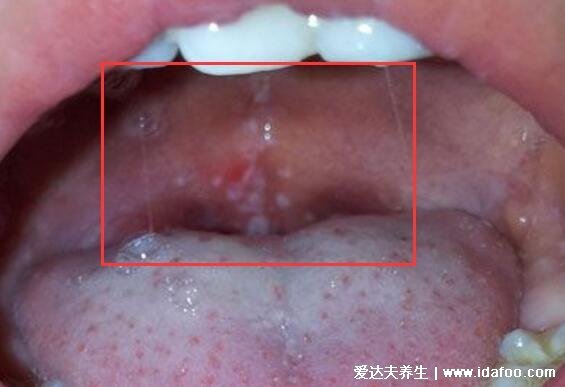 口腔粘膜丘疹圖片，常見的口腔潰瘍/口腔炎/手足口病要學(xué)會(huì)區(qū)分