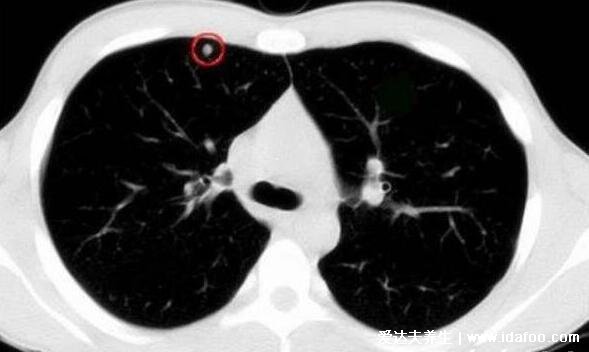 肺部有結節(jié)是怎么回事?要緊嗎?不要驚慌大部分是良性的炎癥