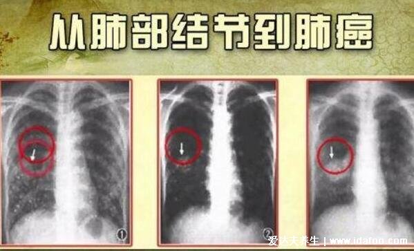 肺部有結節(jié)是怎么回事?要緊嗎?不要驚慌大部分是良性的炎癥