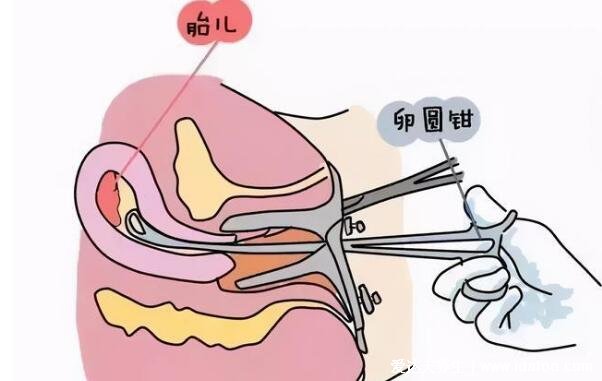 藥流10個(gè)人有9個(gè)流不干凈，不準(zhǔn)確但概率確實(shí)不低(附孕囊掉下來(lái)的圖片)