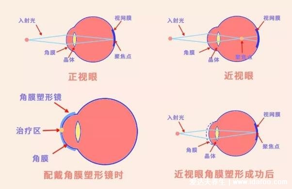 佩戴ok鏡角膜塑形鏡10年后影響，近視加深完全喪失看清楚的能力