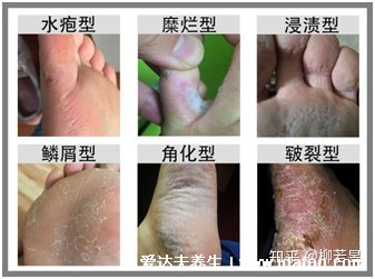 5種普通皮癬圖片早期癥狀，手蘚足蘚成人多見(甲蘚就是灰指甲)