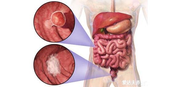 腸癌拉出來大便的圖片，警惕4個(gè)最為明顯的腸癌信號(hào)