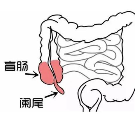 闌尾炎是哪個部位疼位置示意圖片，右下腹按壓痛(早期上腹肚臍疼)