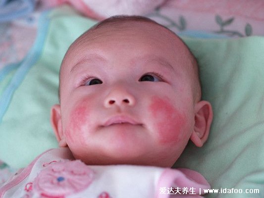 嬰兒奶蘚圖片長什么樣子，頭面部有紅疹還有白屑(出生2到3月要注意)