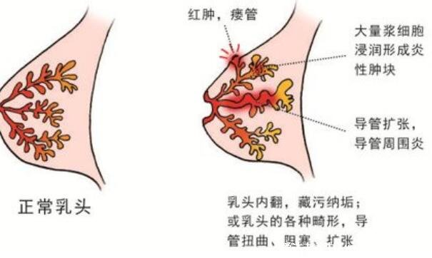 乳腺炎的癥狀表現(xiàn)有哪些癥狀圖片，哺乳期媽媽注意了有3大變化