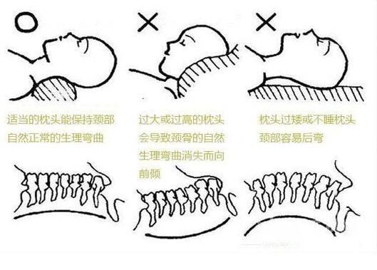 頸椎病正確睡姿圖片，仰臥睡姿/側(cè)臥睡姿要時(shí)常改變方向